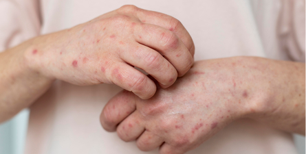 Measles